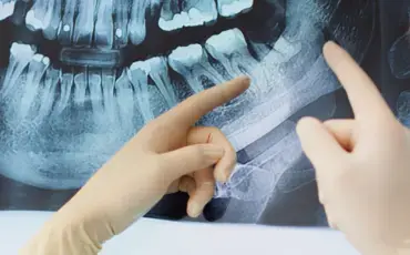 Dental X-ray